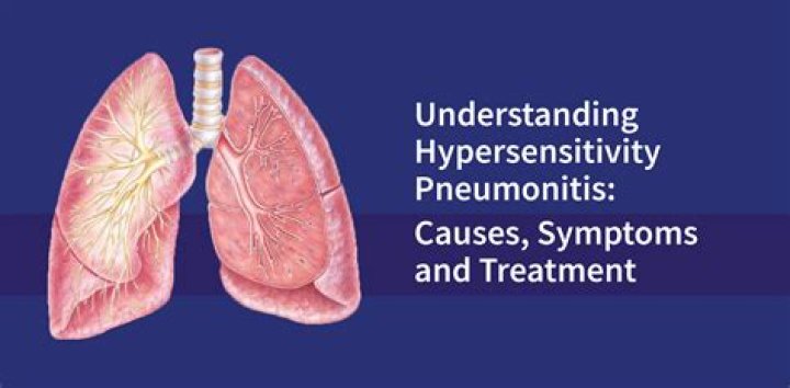 How long can you live with hypersensitivity pneumonitis?