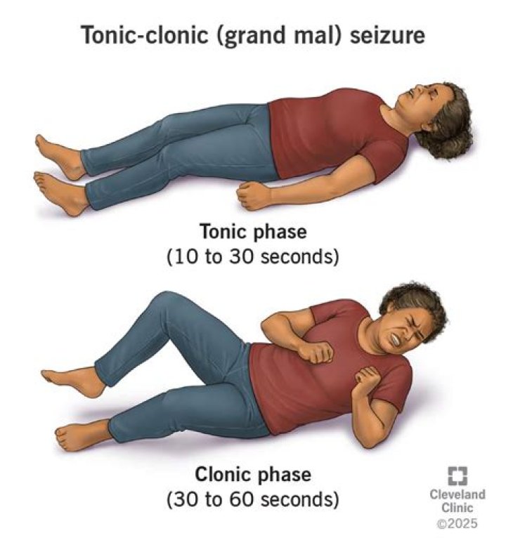 What are the long term effects of a grand mal seizure?